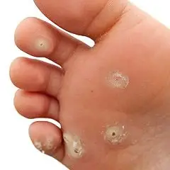 Image of Right Foot infected with Verruca on the skin