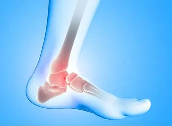 PLantar Fasciitis 2