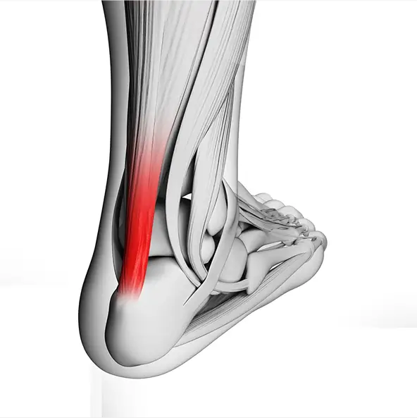 Achilles Tendonitis