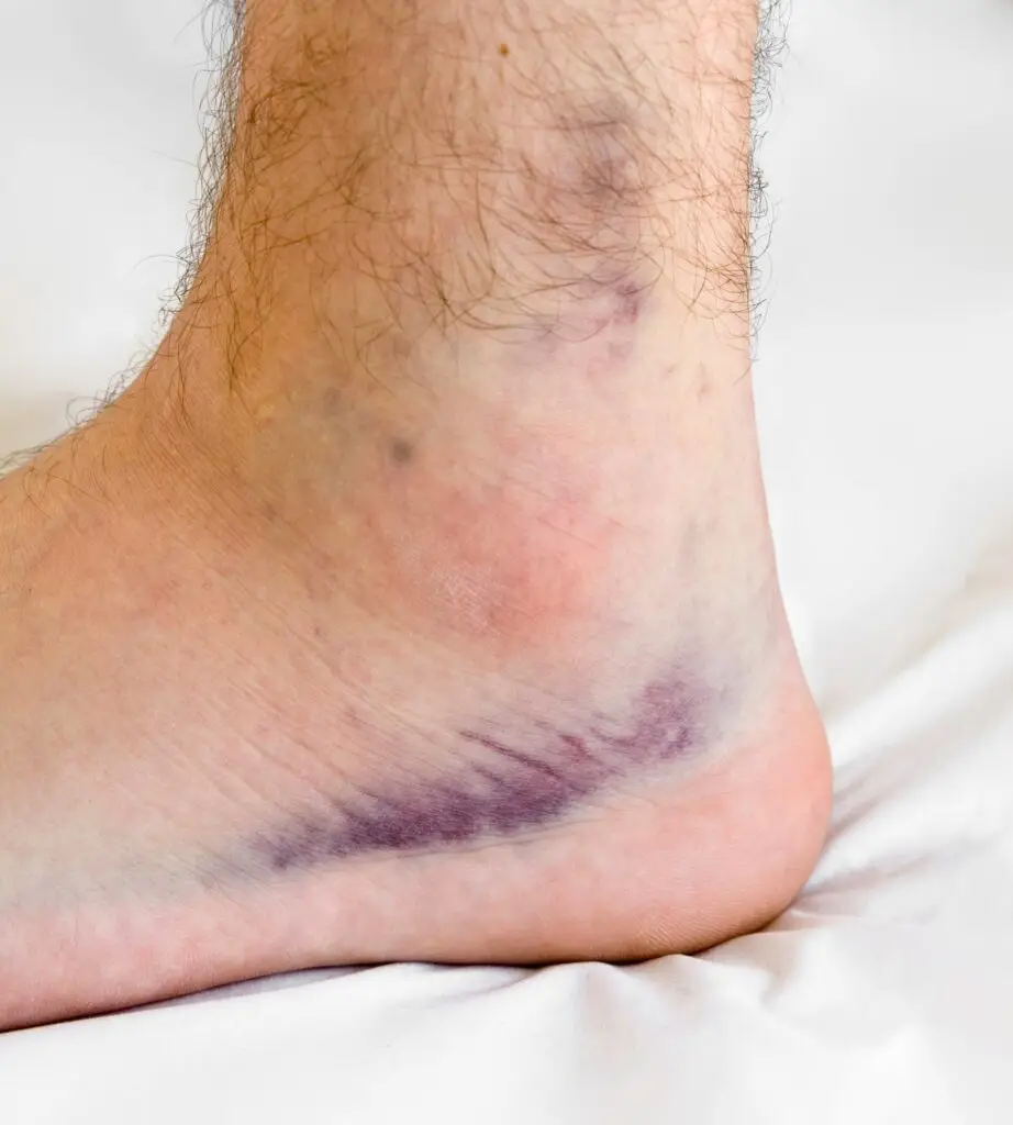 Young man's swollen & bruised sprained ankle.