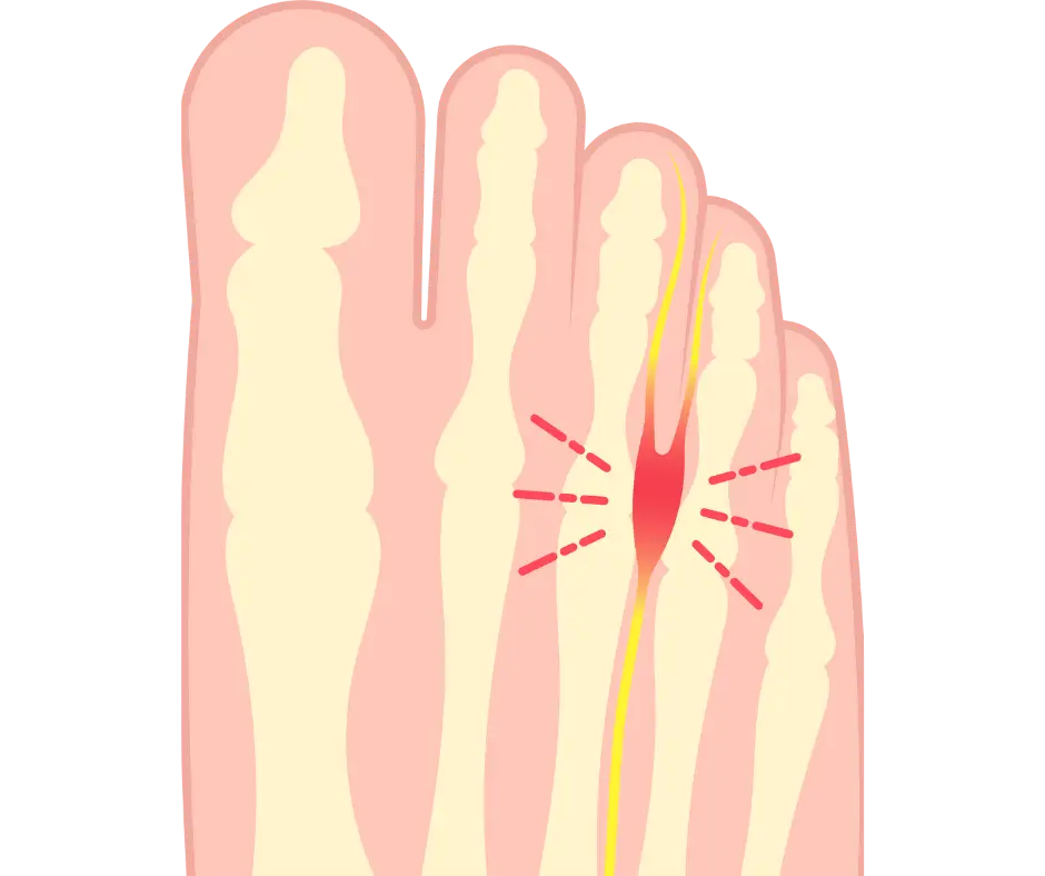 Morton's Neuroma - 2