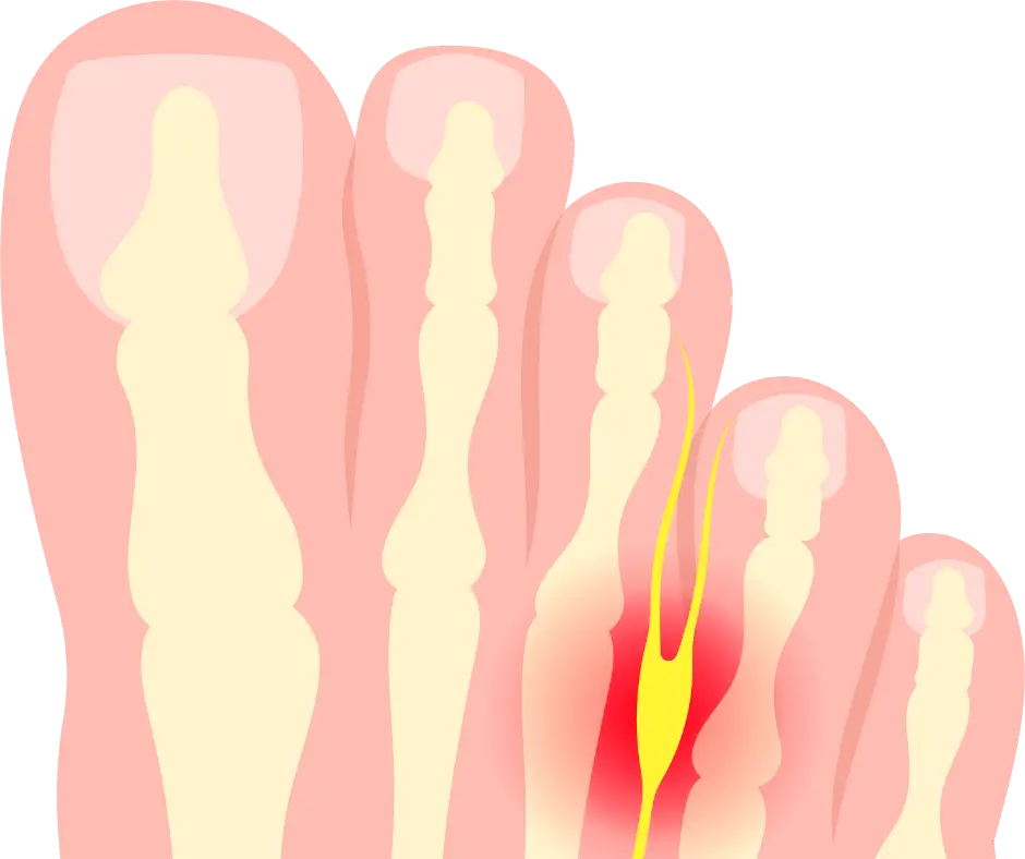 Morton's Neuroma - 3
