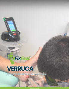5 Ways To Banish Your Verruca Forever