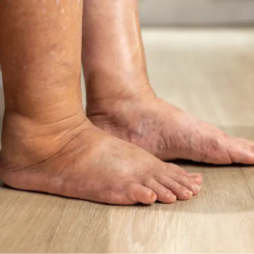 diabetic foot care -1